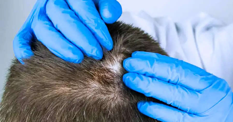 trattamento alopecia a parma