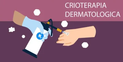 Quando è sconsigliata la crioterapia